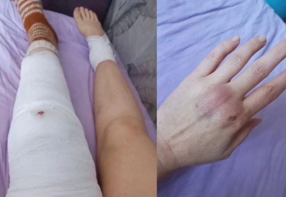 В Нижнем Новгороде женщина получила серьезные травмы после наезда самоката