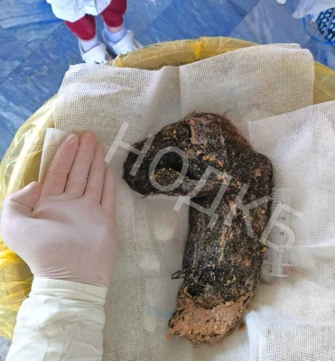 Огромный комок волос вырезали из желудка 17-летней нижегородки